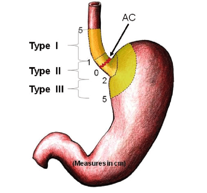 Drawing-showing-Siewert-classification-AC-anatomical-cardia