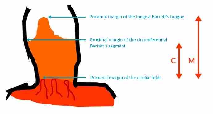 Prag-Klassifikationen-des-Barrett-Oesophagus-ENG