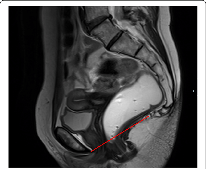 Pubococcygeal-line-PCL-Sagittal-midline-T2-TSE-image-with-the-PCL-represented-red