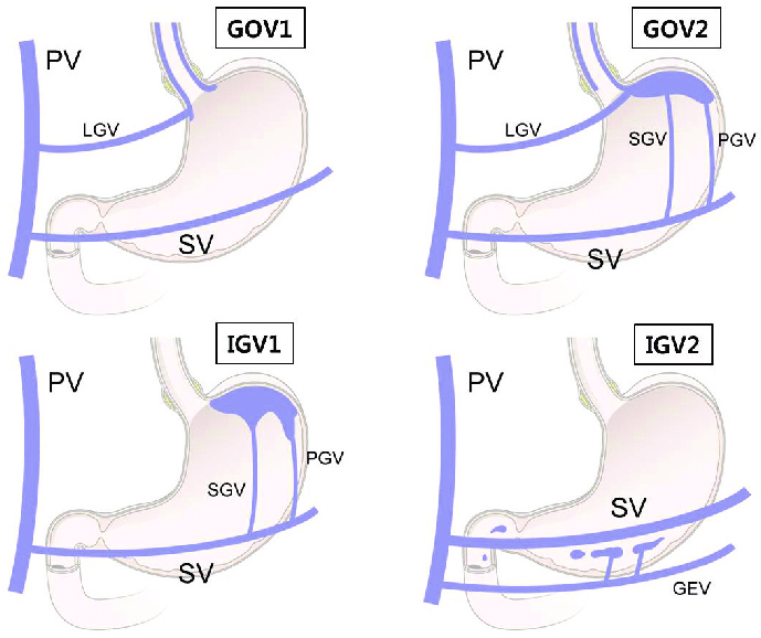 Sarin-classification-of-gastric-varices-GEV-gastric-epiploic-vein-GOV