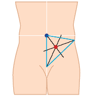 Stoma-marking_344x194.gif