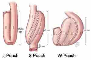 pouch-procedure-2