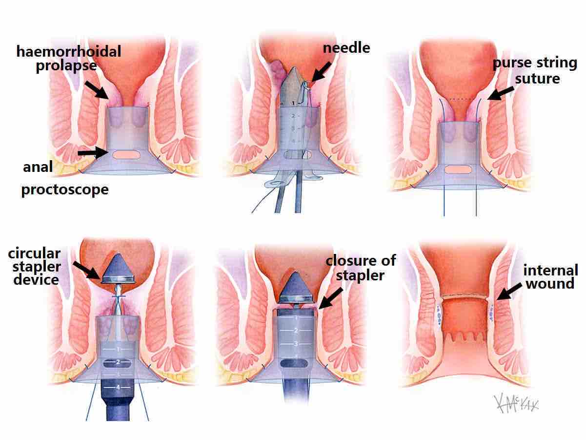 stapled-haemorrhoidectomy_e